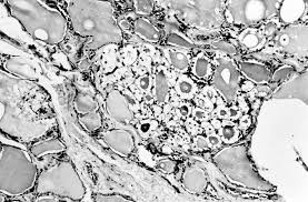 Pathology Outlines Multinodular Goiter