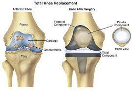 Physical Therapist S Guide To Total Knee Replacement Arthroplasty