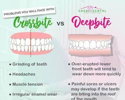 Invisalign for severe bite problems