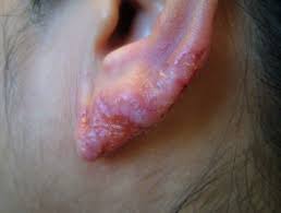 Leo f, tronnier m, grohé c: Cutaneous Tuberculosis Dermnet Nz