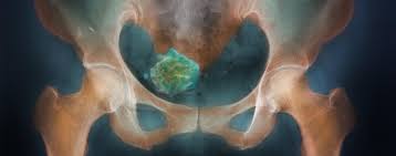 Myom terminolojisi tıbbi literatürde fibroid, uterin fibroid, leiomyoma, myoma uteri gibi isimler verilen myomlar, içlerinde düz kas ve bağ dokusu içeren iyi huylu (kanser olmayan) kitlelerdir. Myome Symptome Und Behandlung Focus Arztsuche