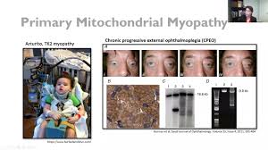 Image result for Myopathy