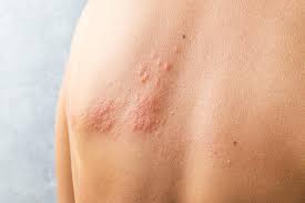 Image result for shingles in children