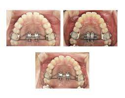 Embrace Dental And Orthodontics I Mse I Marpe Embrace Dental And Orthodontics
