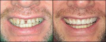 On average, porcelain veneers last somewhere between 10 and 15 years, while composites have a 5 to 7 year lifespan. Porcelain Veneers Linhart Dentistry