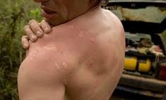 Chem Snyat Bol Pri Ozhoge Www Wday Ru