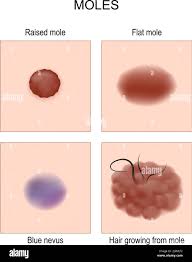 Image result for Blue Nevus