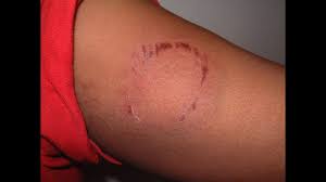 Image result for Human Bite