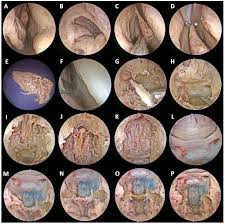Endonasal Part. Extradural Work.