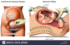 Google Image Result For Https C8 Alamy Com Comp Adtrh8 Cesarean Delivery Adtrh8 Jpg In 2020 Cesarean Cesarean Section Cesarean Delivery