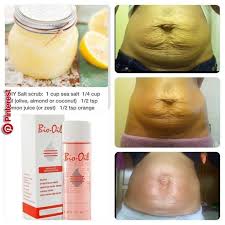 Bio Oil For Stretch Marks Reviews Bio Oil For Stretch Marks Her 10 Year Old Stretch Marks Are Almost Completely Gone In 32 Days Biooilreview Bio Oil Review In 2019 Pinterest St Oil For