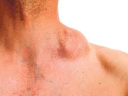 Tanda paling awal adalah benjolan atau ketulan di sekitar kawasan payudara. Bahaya Urut Bengkak Kanser Limfoma