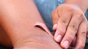 Image result for Tetanus