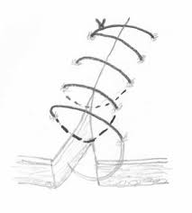 The selection of an appropriate suture pattern is important to the successful outcome of surgery. Caslick Operation From Vetlexicon Definitive Veterinary Intelligence