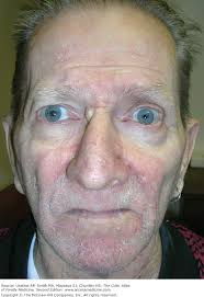 Image result for Beard Dermatitis