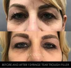 Face Slimming Procedures for Enhanced Contours