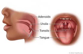 Image result for Tonsillectomy