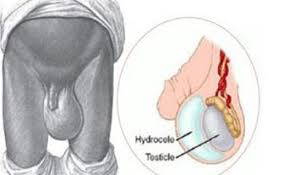 Buah zakar terasa nyeri kenali penyebab dan pengobatannya. Zakar Gambar Testis Normal Pada Bayi