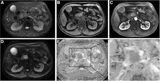 Read more about pancreatic cancer staging. Mri Images Of Histological Proven Pancreatic Cancer In 64 Year Old Man Download Scientific Diagram