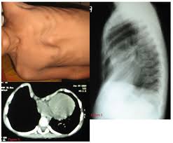 The condition known as pectus excavatum is a bony deformity that tends to get worse with adolescence. Health Reference Center Academic Document An Asymptomatic Radiology Finding With Surgical Indication