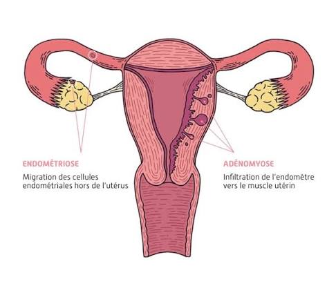 Endométriose et fertilité - CHU de Montpellier