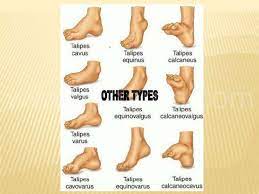 Approximately 50% of cases of clubfoot affect both feet. Before Going To Doctor Which Must Know About Clubfoot
