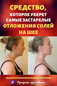 как избавиться от отложения солей на шее в домашних условиях Sredstvo Kotoroe Pomozhet Ubrat Dazhe Samye Zastarelye Otlozheniya Solej Na Shee Health Health Motivation Natural Health Remedies