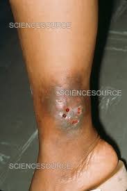 Image result for syphilis ulcer