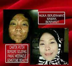 Jerawat & parut akan clear habis. Kenapa Kesan Meeracle Berbeza Meeracle Gemstone Nurul Facebook