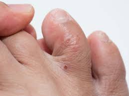 Image result for pompholyx soles of feet
