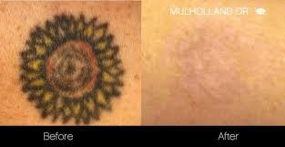 4.1 tattoo shop and artist. Laser Tattoo Removal Clinic Toronto See Our Before Afters