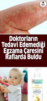 Doktorlarin Tedavi Edemedigi Egzama Caresini Raflarda Buldu Anne Paige Sweeney Kizi Evie Rae Yi Iki Sene Boyunca Bircok Der Doktorlar Saglik Saglik Urunleri