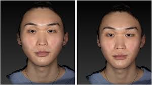 Facial Feminization