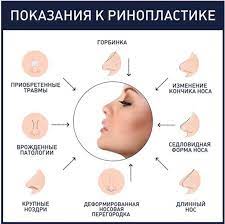 Ринопластика (пластика носа) в Москве | Цены на операцию в клинике  пластической хирургии EMC
