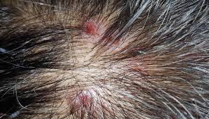 Image result for folliculitis symptoms
