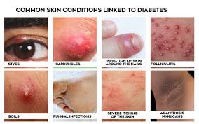 What does a chickenpox rash look like? Everything About Diabetic Dermopathy Diabetes Foot Problem