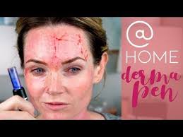 Microneedling At Home Derma Pen Before And After Youtube Derma Pen Microneedling Derma Roller