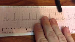 12 lead normal sinus rhythm ekg. Looking At A Normal 12 Lead Ecg Youtube