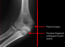 Medial epicondyle fractures represent almost all epicondyle fractures and occur when there is avulsion of the medial epicondyle. Distal Humerus Fractures Medial Epicondylar Fracture
