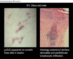 Image result for koebner phenomenon psoriasis