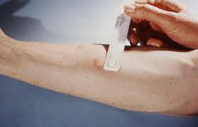 This bacteria spreads when you take in the air breathed out by a person infected with tb. What Does A Positive Tb Skin Test Look Like