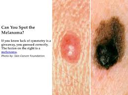 As far as what sunscreen to buy and how to apply it properly, you may be lost. Would You Know Skin Cancer If You Saw It