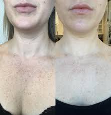 Achieve smooth, silky skin with the latest technology aureoled hair . Ipl Before And After Photo Gallery Elk Grove Folsom Roseville El Dorado Hills Sacramento Ca Destination Aesthetics