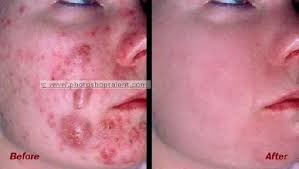 Bio Oil Before And After Face Pin On Before And After Mederma And Bio Oil