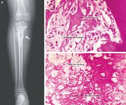 Image result for Osteosarcoma