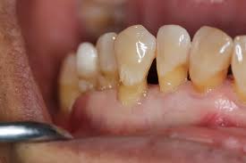 Image result for Gingivitis