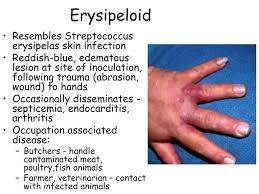 Image result for Erysipeloid