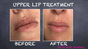 In contrast, the results of laser hair removal are long lasting but not always permanent. Hildi Permanent Hair Removal Professional Multi Probe Electrolysis Photos Facebook