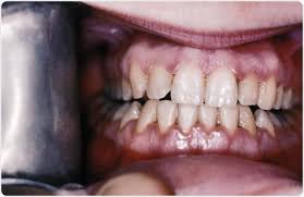No need to register, buy now! What Is Gingivitis