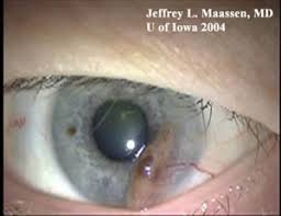 Image result for conjunctival melanoma